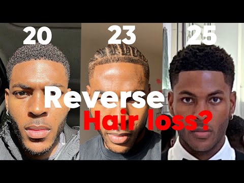 STOP hair loss in your 20s ( NO HAIR TRANSPLANT )