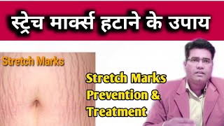 Stretch Marks ka ilaj and Gharelu Upay | How to Remove Stretch mark ......