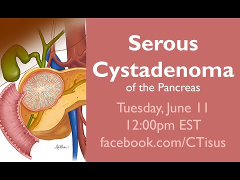 Facebook Live: Serous Cystadenoma of the Pancreas