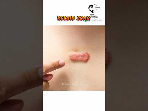 What are Keloids? Dr. Isacc Abbas