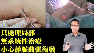 靜脈曲張只處理局部，無系統性治療，小心再復發｜許原彰醫師：台中，高雄，台南，台北，新竹，靜脈曲張專家