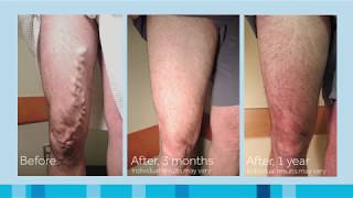 Varicose Vein Treatment - Steve's VenaSeal Story