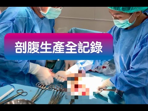 孕婦剖腹產 生產過程 小Micky生產紀錄 膽小勿看