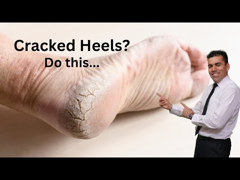 Cracked Heels? This could be a very bad sign never ignore it and fix it by doing these steps.