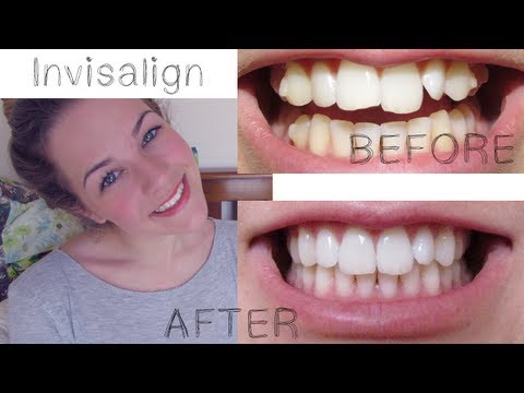 My Invisalign Treatment