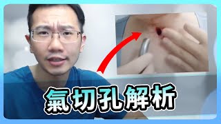 脖子上直接開洞放管子? 氣切手術解析 | 瀾教短EP44 #shorts