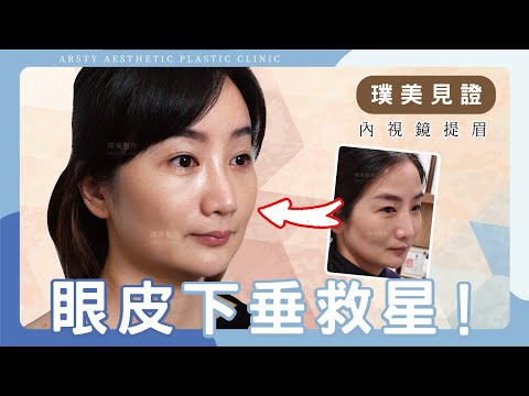 【#內視鏡提眉】#眼皮下垂 救星！拉提效果CP值最高的療程是什麼？ | 璞美整形外科醫美診所