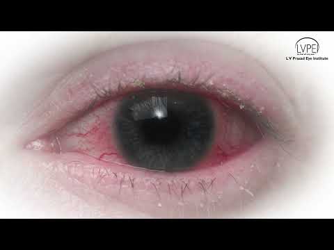 How to prevent Conjunctivitis?