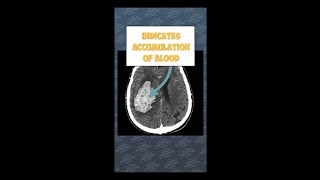 How Intracerebral Haemorrhage Looks on CT Head: A Medical Student's Guide#science #anatomy