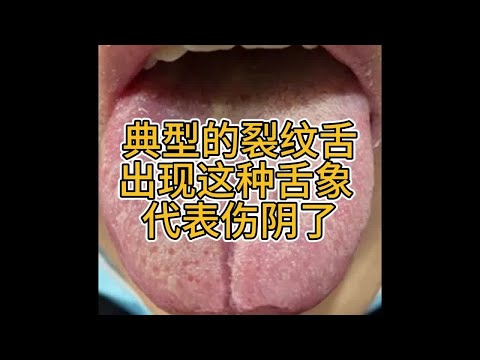 典型的裂纹舌 出现这样的舌头 代表伤阴了