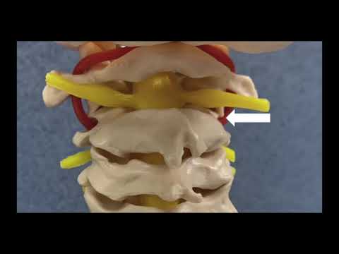 C1–2 facet disarticulation for correct of iatrogenic cervical kyphosis after occipital-cervical ...