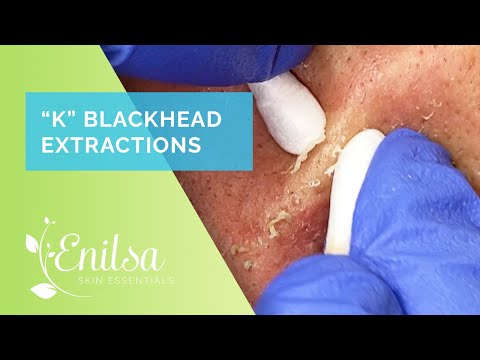 Blackhead & Whitehead Extractions on "K" Part 4