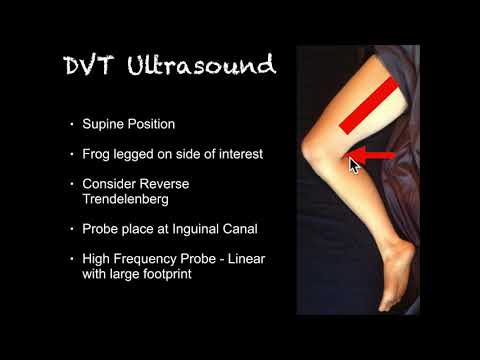 POCUS -  Right Lower Extremity Deep Venous Thrombosis (DVT)