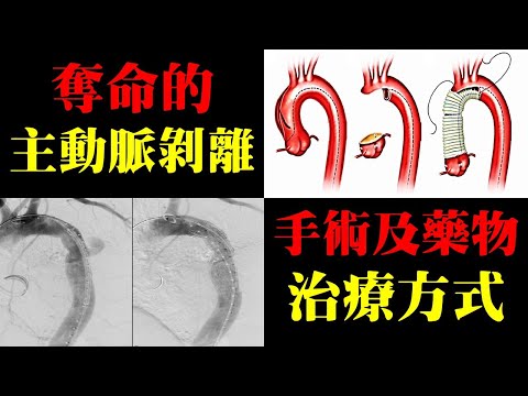 奪命的主動脈剝離，手術及藥物的治療方式｜許原彰醫師