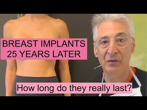 Do I NEED to Change My Breast Implants EVERY 10 YEARS? 25 Year Patient Follow Up!