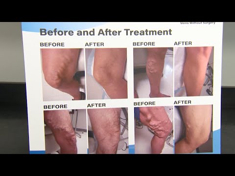 Varicose Vein Removal in Chicago at Veins Without Surgery