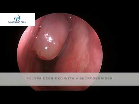 Infected mucocoele (mucopyocoele) from massive nasal polyps