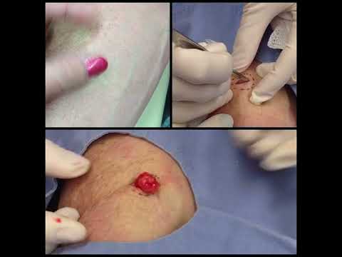 Lipoma Forearm Pop