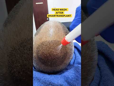 Hairtransplant - Headwash #hair #haircare #hairloss #shorts