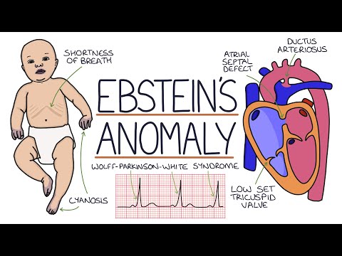 Understanding Ebstein's Anomaly