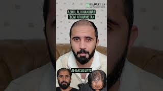 20 Days of Transformation of Abdul Ali Khandhar from Afghanistan!