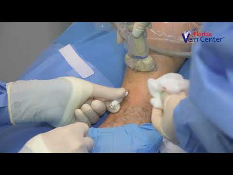 Venaseal Video at Florida Vein Center