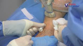 Venaseal Video at Florida Vein Center