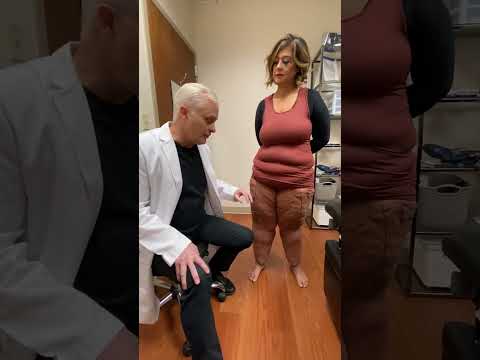 Dr Wright shows leg lobules on a Type 3 Stage 3 Lipedema discusses treatment of lipedema lobules