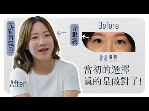 【無痕式眼袋見證】當初這個選擇，真的是做對了！ 李昱恆醫師｜諾雅整形外科