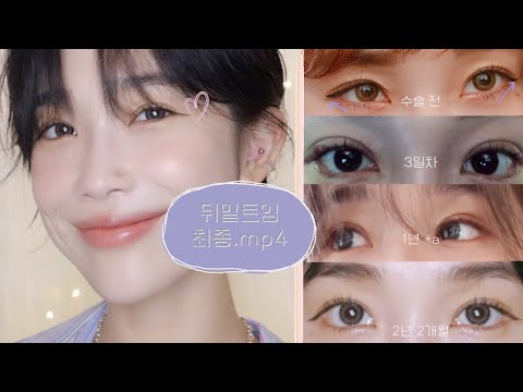 뒤밑트임 최종.mp4 아직 고민중이라면 꼭 보세요❕ 👀 2년 2개월차(돌아온 눈웃음, 안구건조증? 속눈썹과 눈물고임 다 알랴줌🔥)