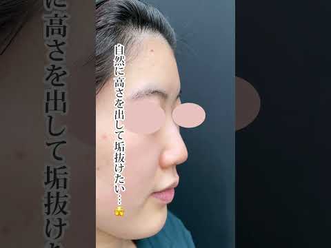 鼻中隔延長(鼻中隔軟骨)＋鼻尖形成3D法＋鼻尖部軟骨移植【形成外科専門医の鼻整形】 #形成外科専門医 #鼻整形 #鼻中隔延長 #鼻整形ダウンタイム