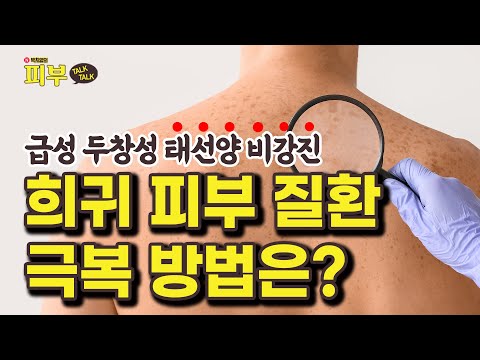 진단도 어렵고 뚜렷한 치료법도 없다는 ‘급성 두창성 태선양 비강진’ 어떻게 극복할까? - 박치영의 피부 톡톡 #155