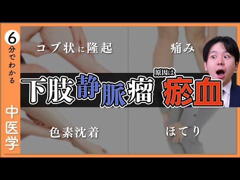 【下肢静脈瘤】原因は「瘀血（おけつ）」【9割が知らない中医学】