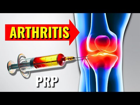 PRP Injections for Severe Knee Osteoarthritis: You've Been Lied To