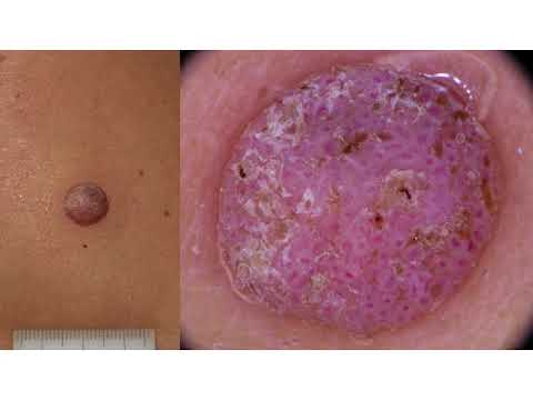 False Positive Seborrheic Keratoses - Dr. Aimilios Lallas