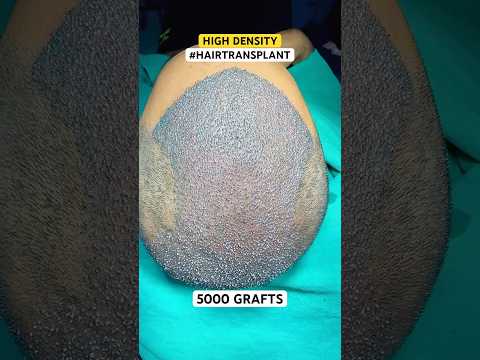 #hair transplant #hair #hairloss #besthairtransplant #drpranilmore #ytshorts #shorts #highdensity