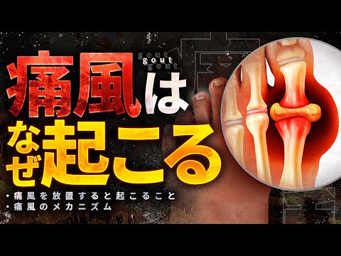 【驚愕】知らないと後悔する人間が痛風になる理由