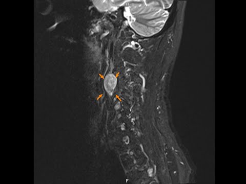 頸部神經瘤 神經鞘瘤 手術 Surgery for Neurogenic Tumor of Neck: Schwannoma Neurilemoma