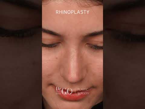 Rhinoplasty - Before & After