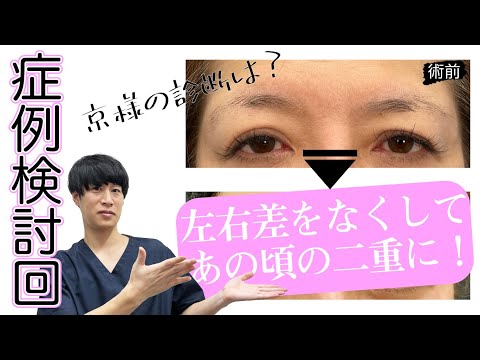 【症例検討回その②】それ本当に埋没法適応？？？【美の主治医京様】