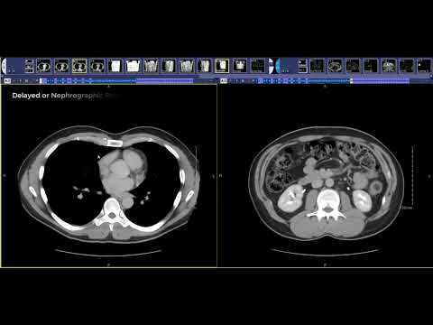 How to read a Kidney Donor CT