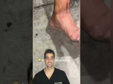 Severely Crooked Toe Correction