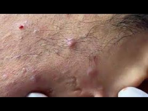 Best Removal Pimple Popping Blackheads - large blackheads removal - best pimple popping