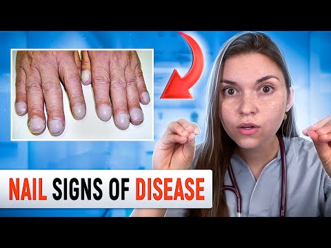 Doctor Explains what your NAILS say about your HEALTH: Top 10 Nail Problems