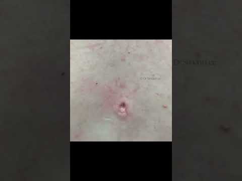 Some Clean Pops from Dr. Pimple Popper