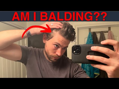 How to SPOT Early Signs of Balding (Catch Androgenic Alopecia FAST)