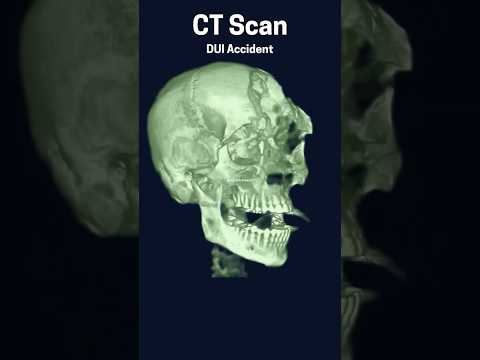 Head CT Scan of Drunk Driving Accident #MADD #savealife #radiology #safety