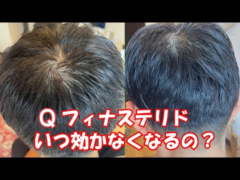 【薄毛・AGA治療】Q：フィナステリドいつ効かなくなるの？AGA治療の限界とは？