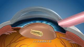 雷射白內障手術 vs 傳統超音波乳化手術