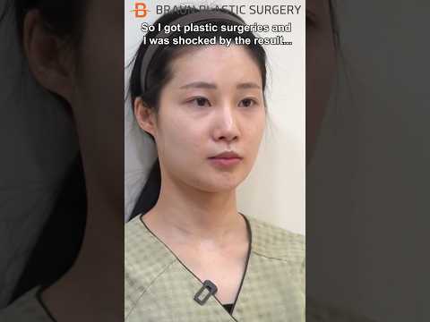 The result is so…😳#fyp #glowup #beforeandafter #facialcontouring #doubleeyelid #plasticsurgerykorea